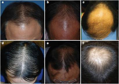 Выпадение волос у мужчин. Причины, средства, профилактика
